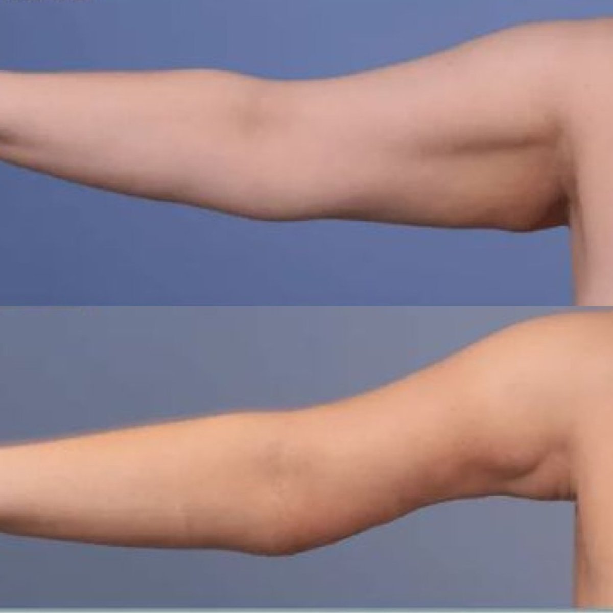Resultados de liposucción de brazos antes y después en Hisar Hospital Intercontinental, brazos más delgados