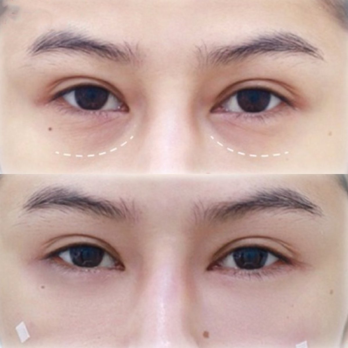 Before and after fillers injection under eyes – reduced dark circles and smoother skin result