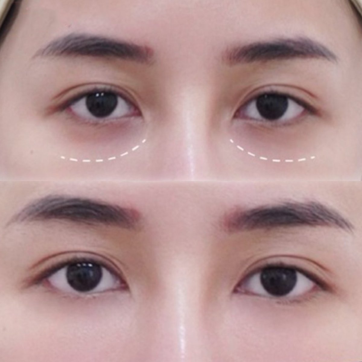 Before and after under-eye fillers injection results – reduced dark circles and smoother skin