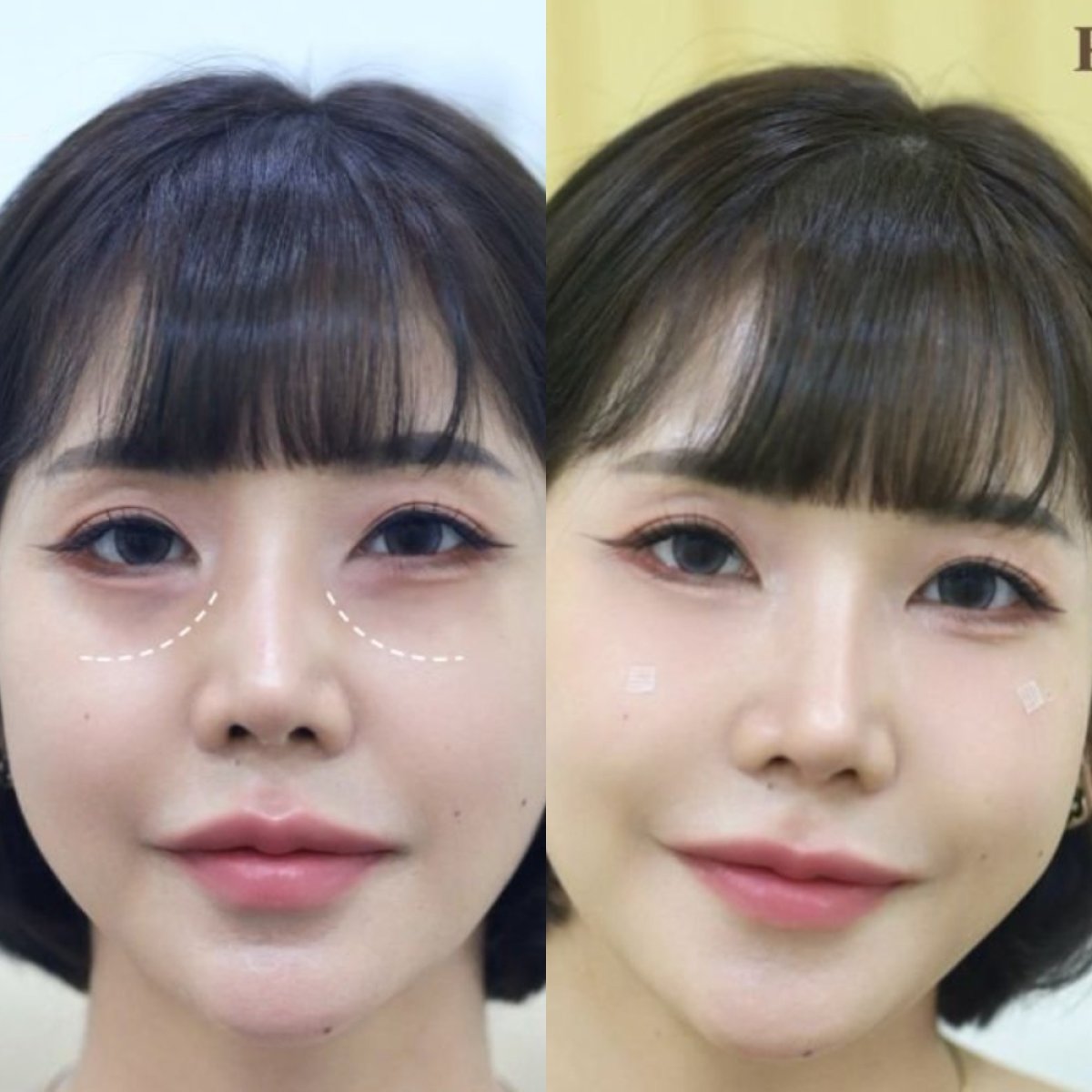 Before and after fillers injection under eyes, visible reduction of dark circles and smooth skin result