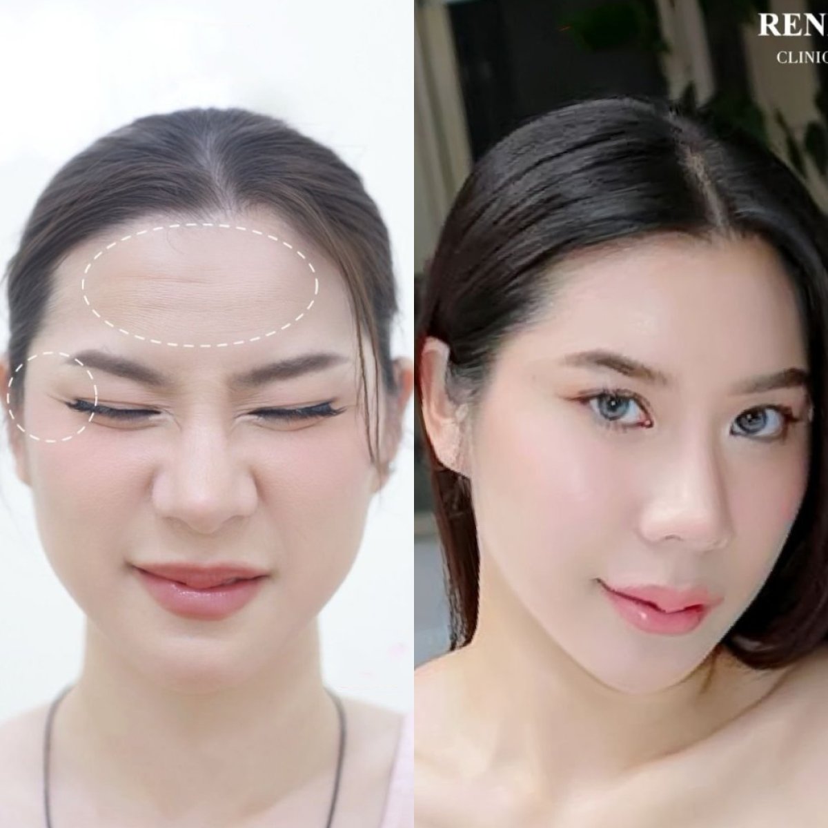 Resultados antes y después de botox para arrugas en clínica – frente y ojos más lisos
