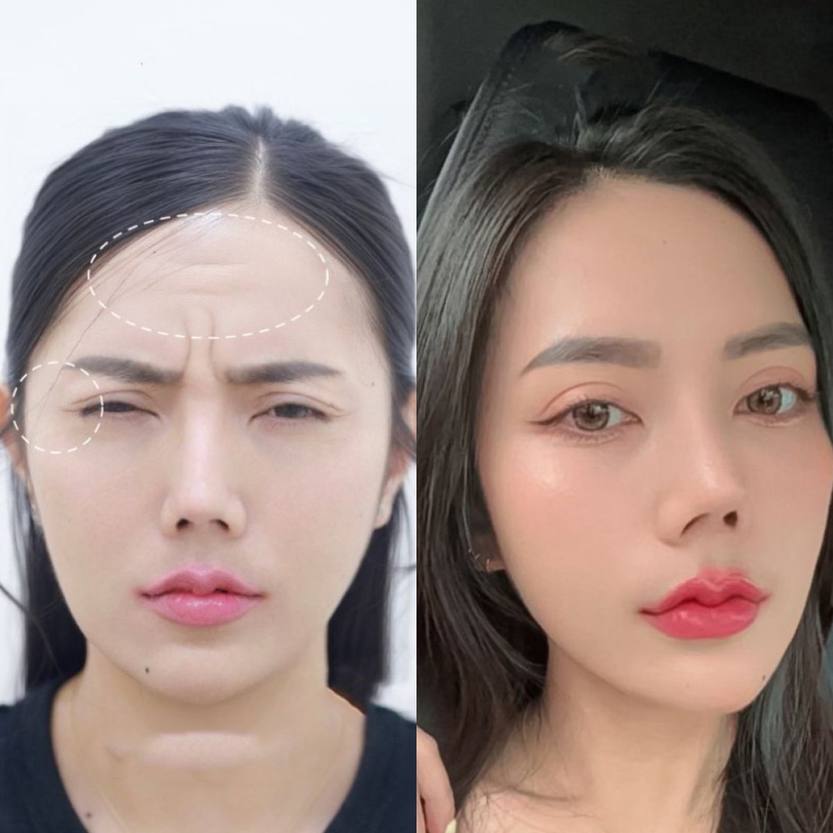 Antes y después de botox para arrugas, frente lisa y piel rejuvenecida resultado