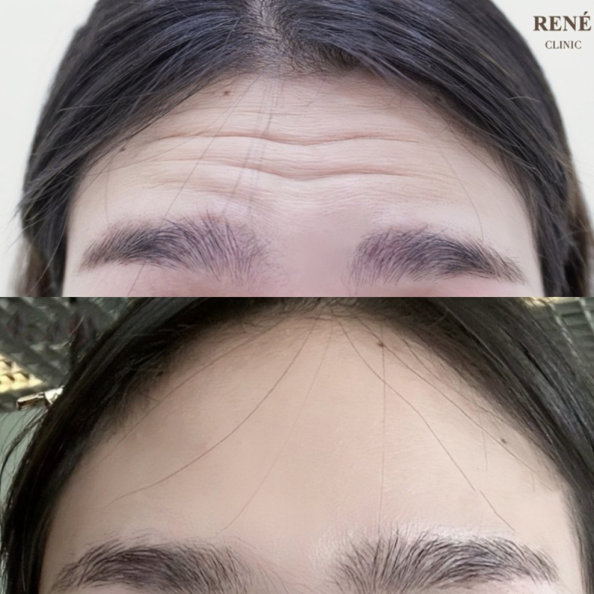 Resultados de botox para arrugas en RENÉ Clinic: frente más lisa antes y después