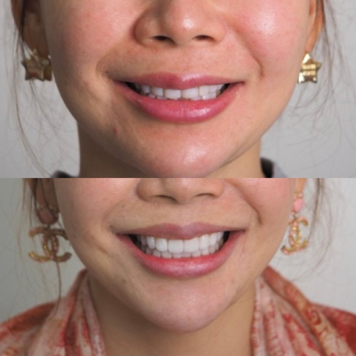 نتيجة قبل وبعد الفينير في عيادة Dentist at home، تشونبوري – تحول الابتسامة