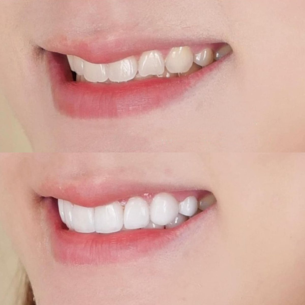 نتيجة قبل وبعد الفينير في عيادة Dentist at home، تشونبوري – تحول الابتسامة