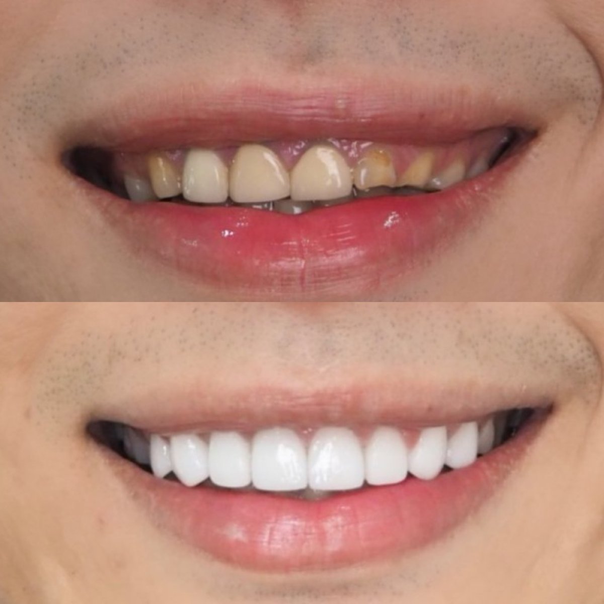 Résultat avant/après facettes chez Dentist at home Clinic, Chonburi – sourire transformé