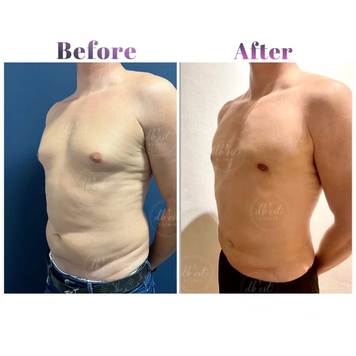 Before and after gynecomastia surgery results at Db'est Clinic – improved male chest contour