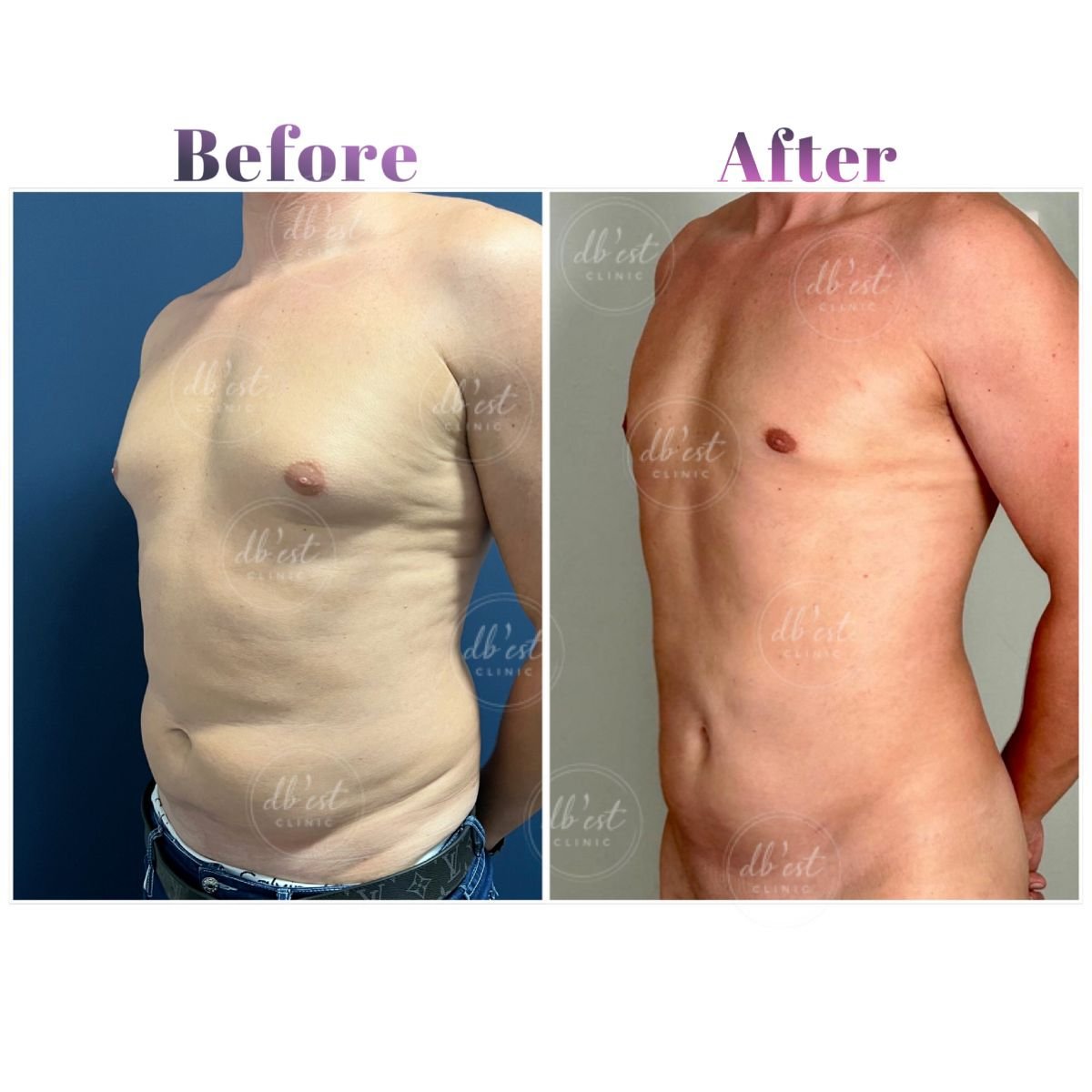 Before and after gynecomastia surgery results at Db'est Clinic – flatter male chest contour