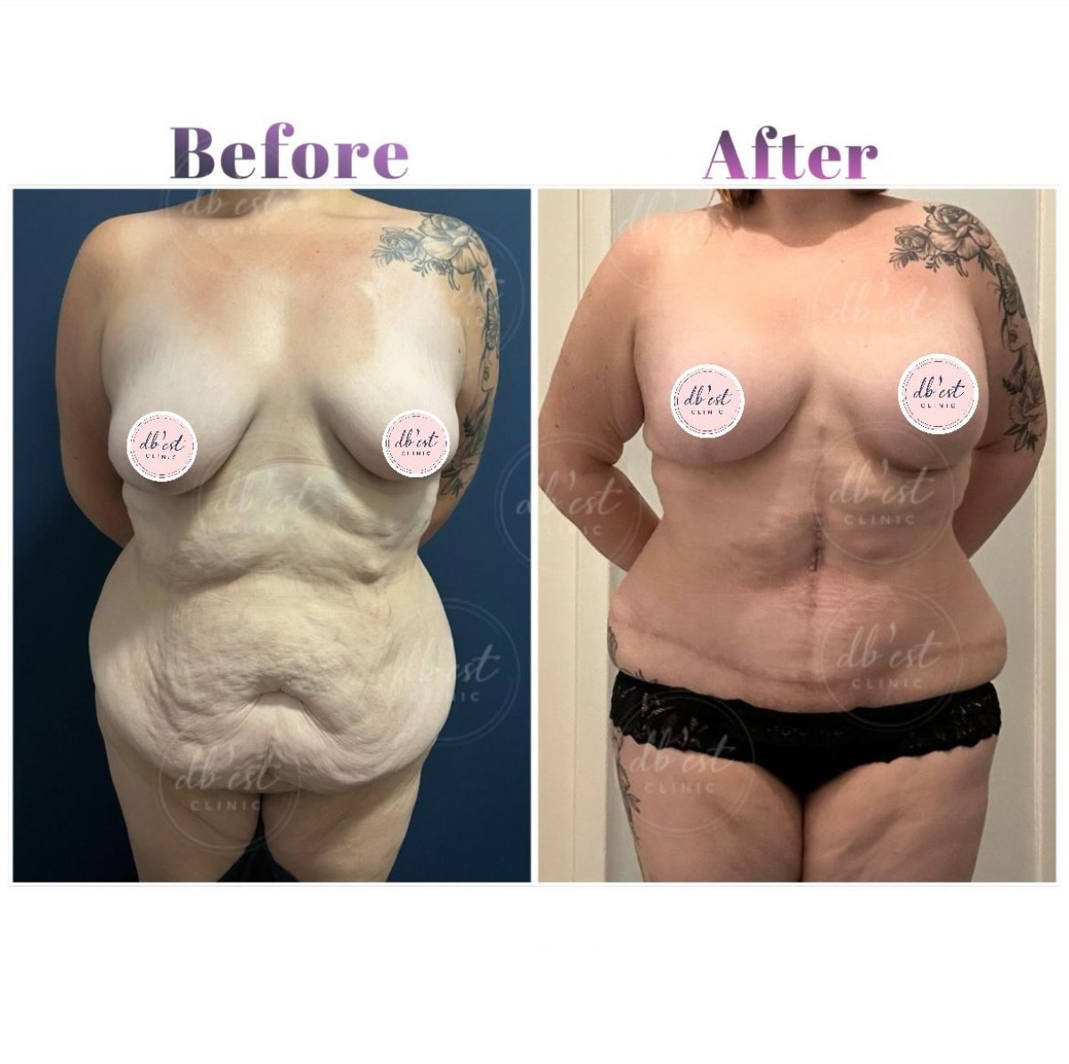 Full body lift before and after results at Db'est Clinic – improved body contour and skin tightness