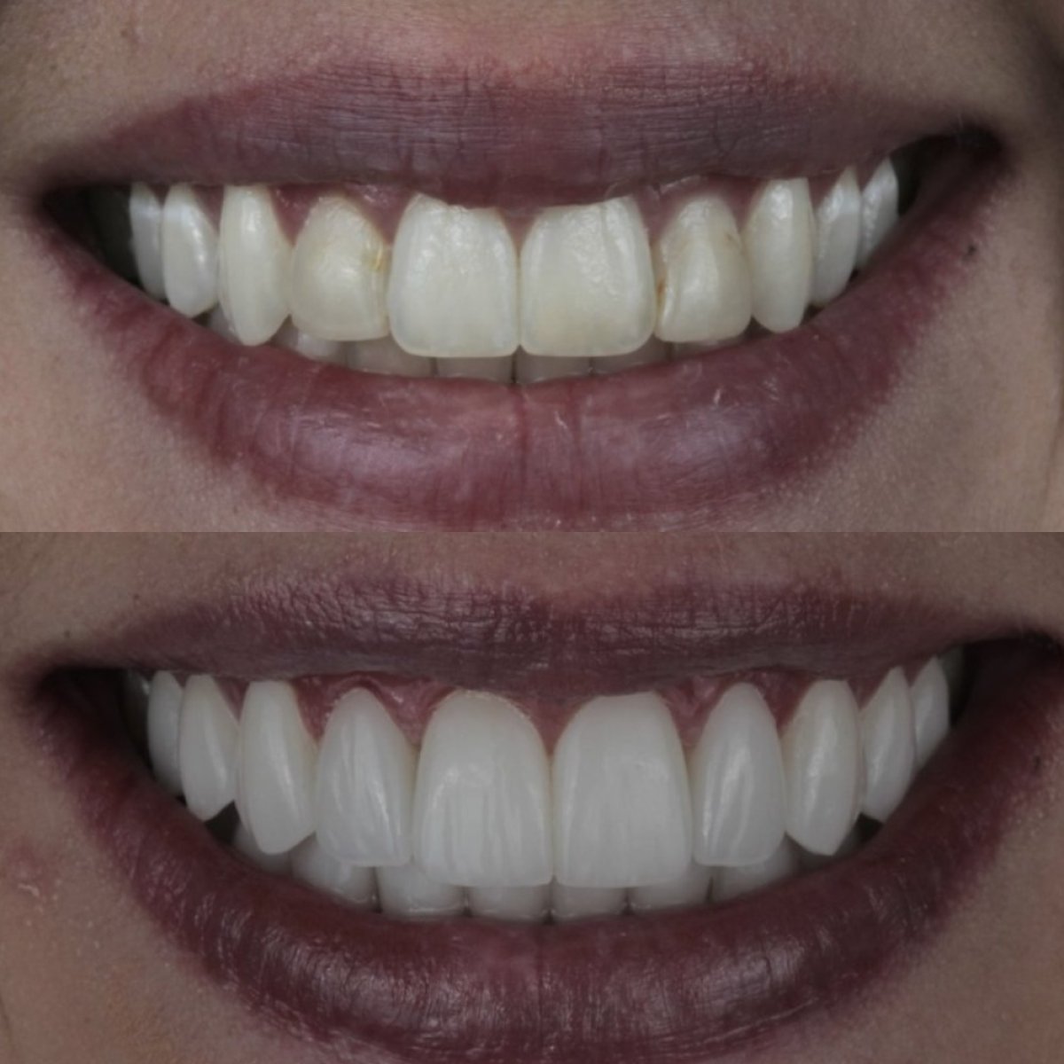 Vorher-nachher-Ergebnis Porzellanveneers – verbesserte, weißere Zähne und schönes Lächeln