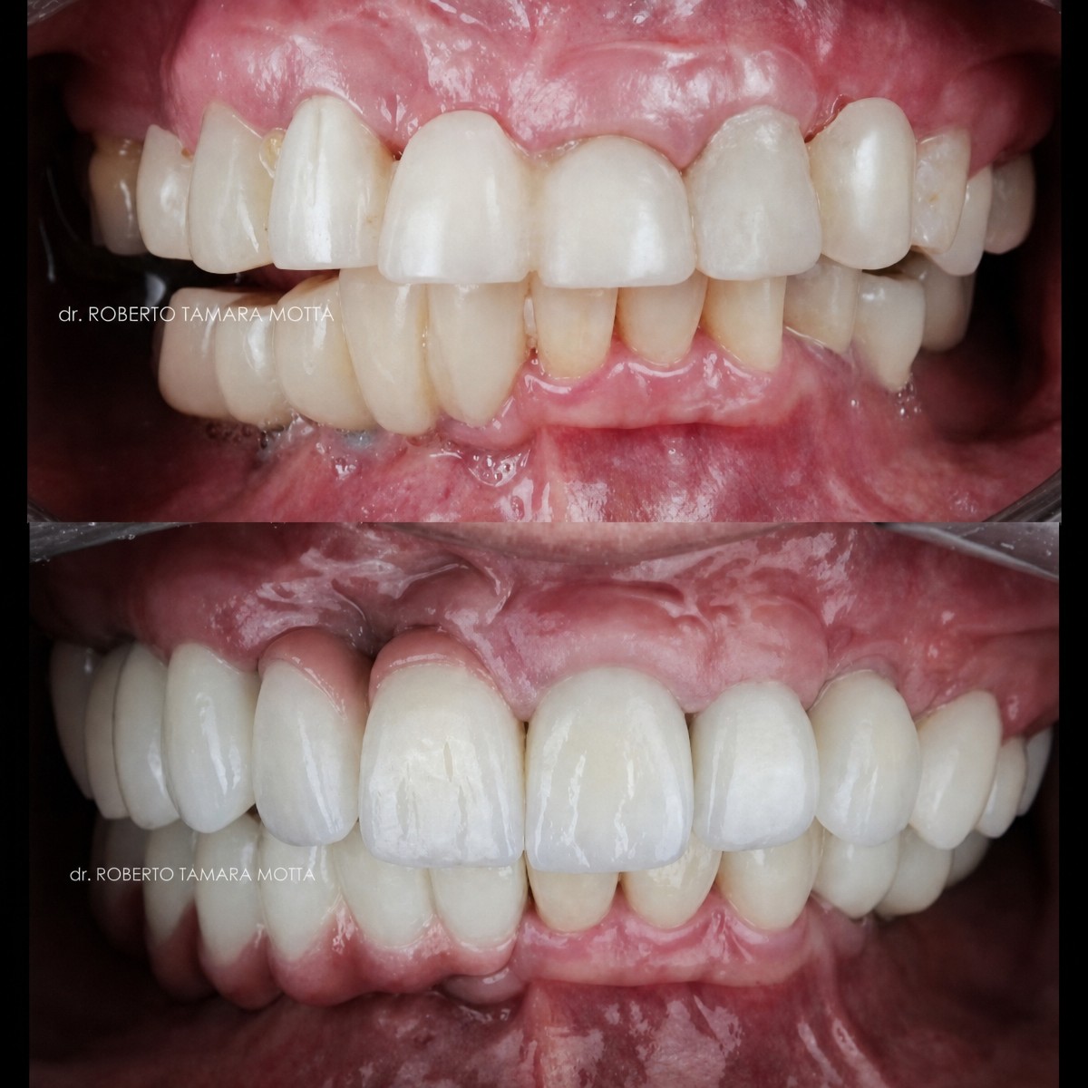 Smile makeover before and after results with dental veneers – improved teeth alignment and color