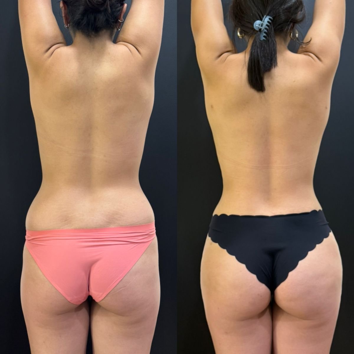 Antes y después de implantes de glúteos en Dr. Alexandro Aguilera - Plastic Surgery, contorno mejorado