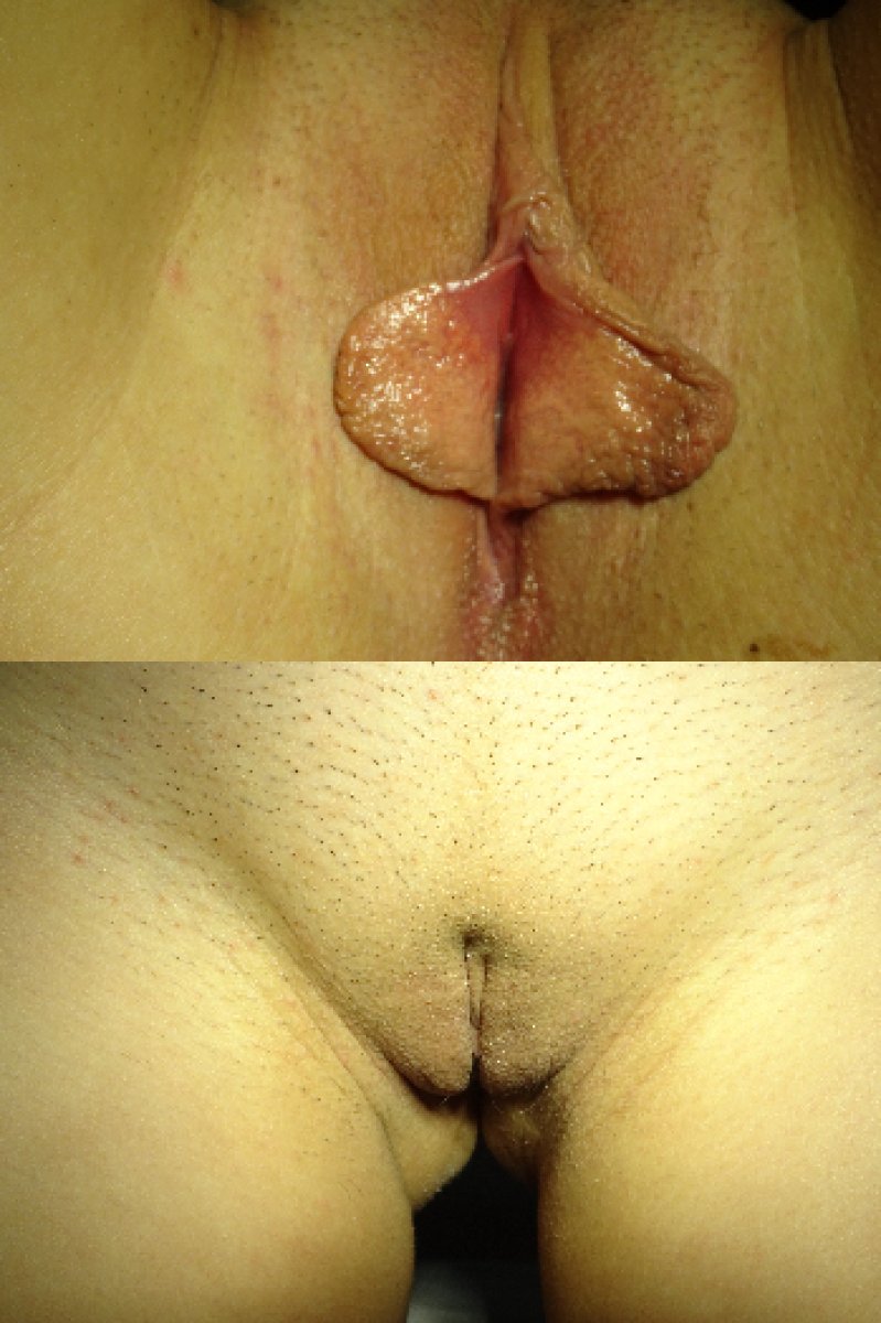 نتائج تجميل الشفرين قبل وبعد، تحسين شكل وتناسق الشفرين بعد العملية