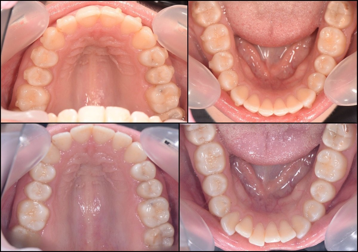 Before and after braces results at RIKOTA Dental Clinic – improved teeth alignment visible