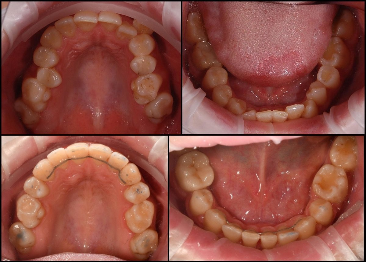 Before and after braces results at RIKOTA Dental Clinic – improved teeth alignment visible