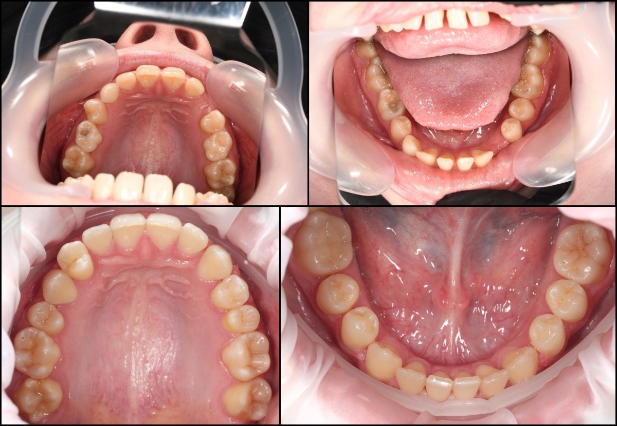 Résultats avant/après appareil dentaire à RIKOTA Dental Clinic – alignement amélioré