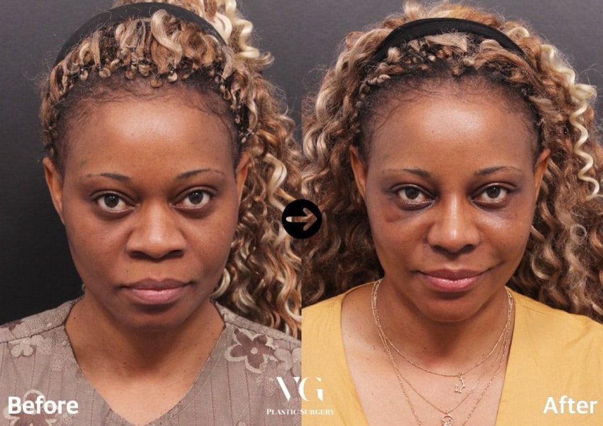 نتائج قبل وبعد عملية تصغير فتحات الأنف في VG Plastic Surgery، تغيير واضح لشكل الأنف