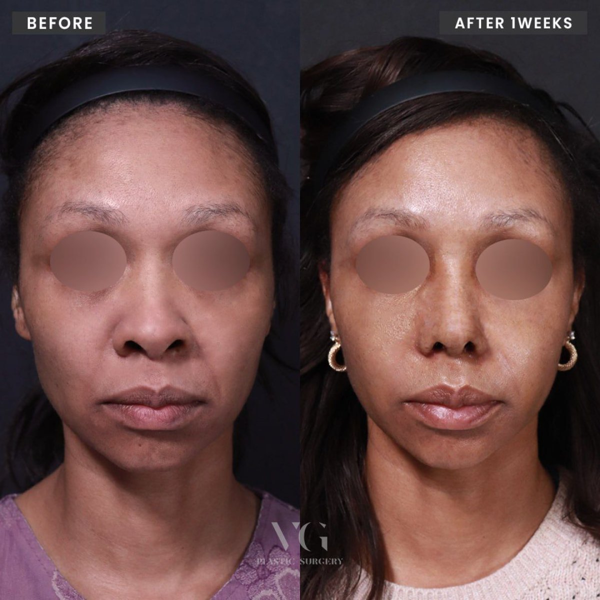 Результати аларопластики до і після у VG Plastic Surgery, покращена форма та симетрія ніздрів