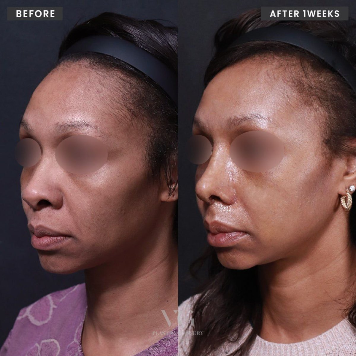 Результати до і після аларопластики у VG Plastic Surgery, покращена форма і контур ніздрів