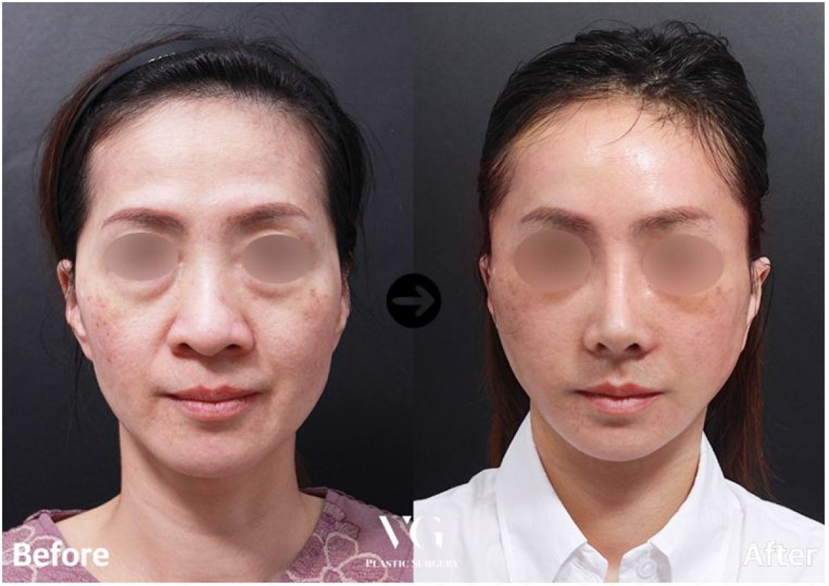 Результати аларопластики до і після у VG Plastic Surgery, покращений контур і симетрія носа