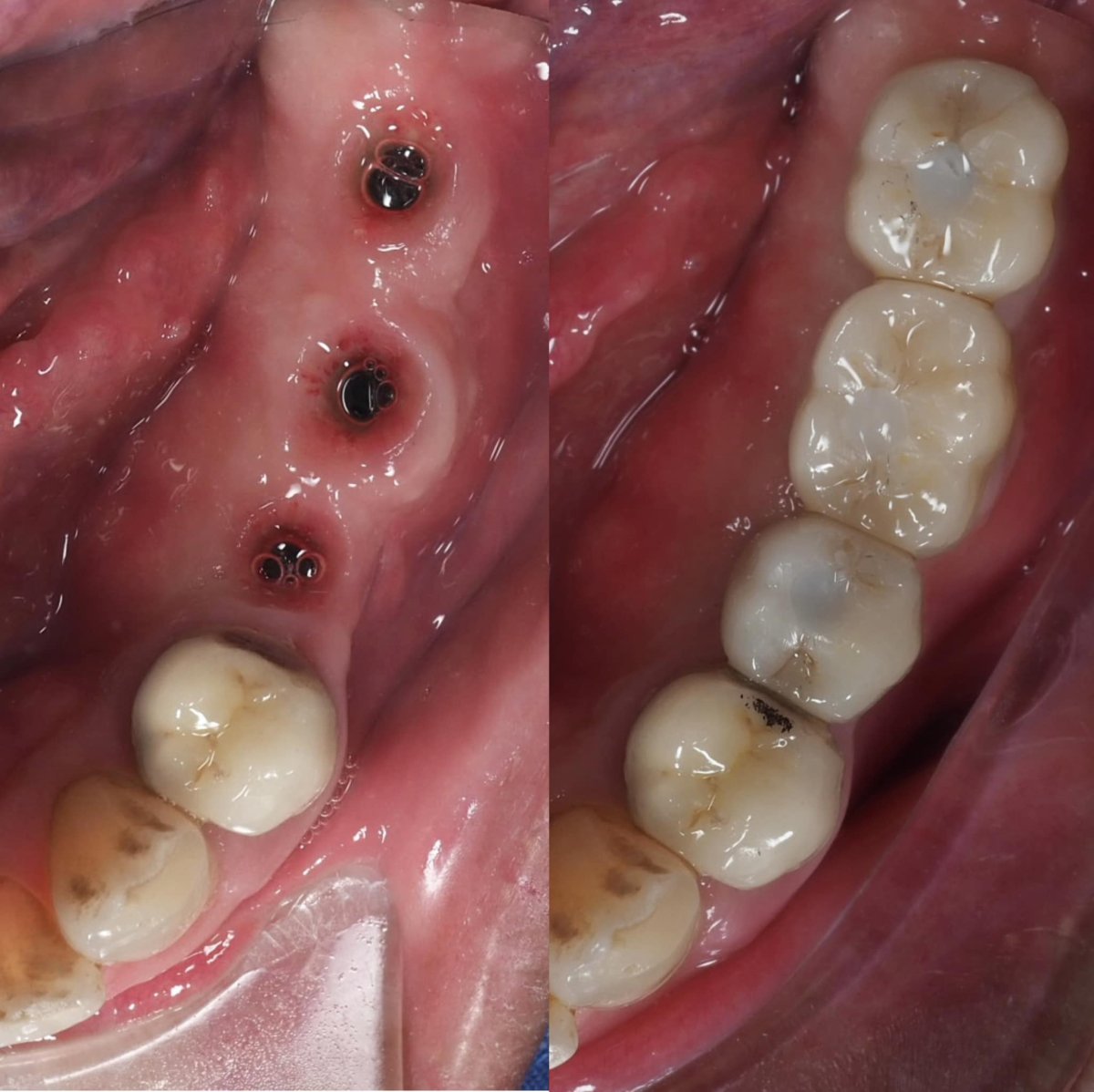 Результаты до и после имплантации зубов в Dentist at home Clinic, Chonburi – восстановленные моляры