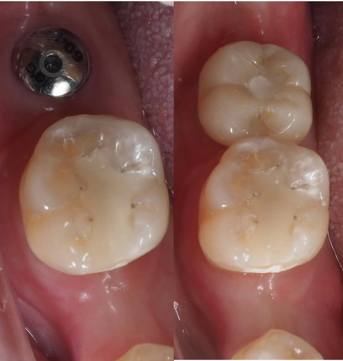 Dental implant before and after result at Dentist at home Clinic, Chonburi – restored molar