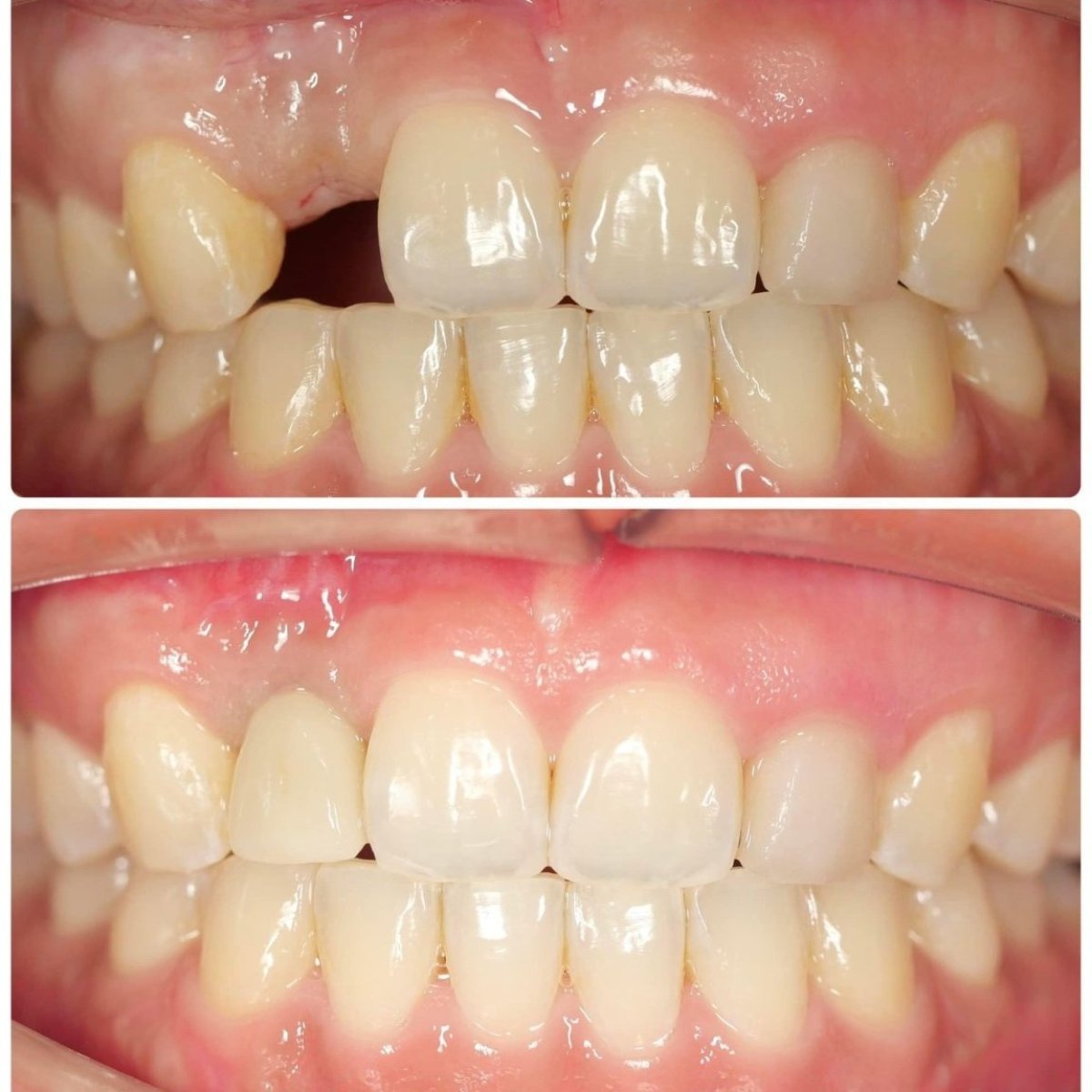 قبل وبعد تركيب تاج الأسنان في Dentist at home بانكوك – استعادة السن الأمامي