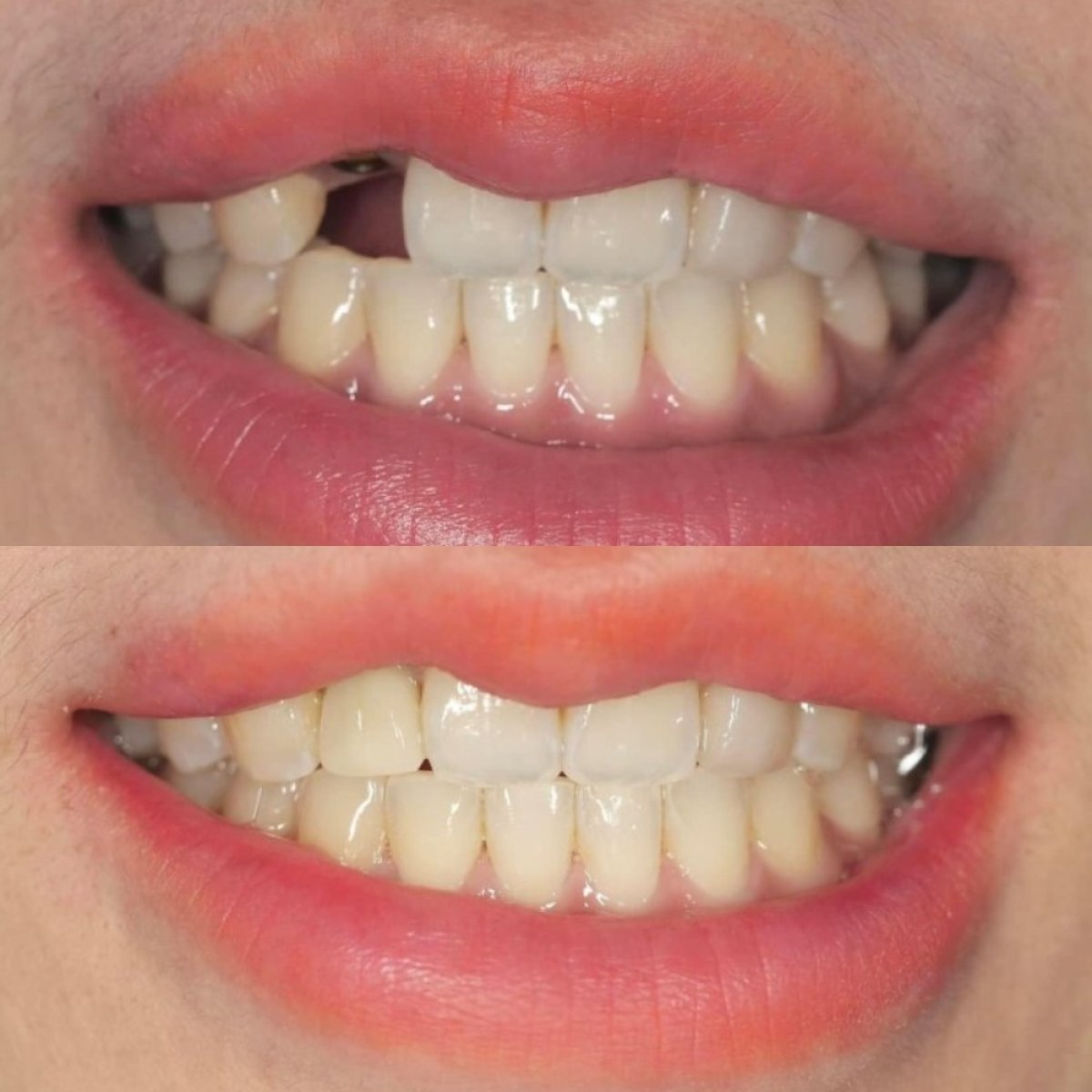 Before and after dental crown installation at Dentist at home, Bangkok – restored smile result