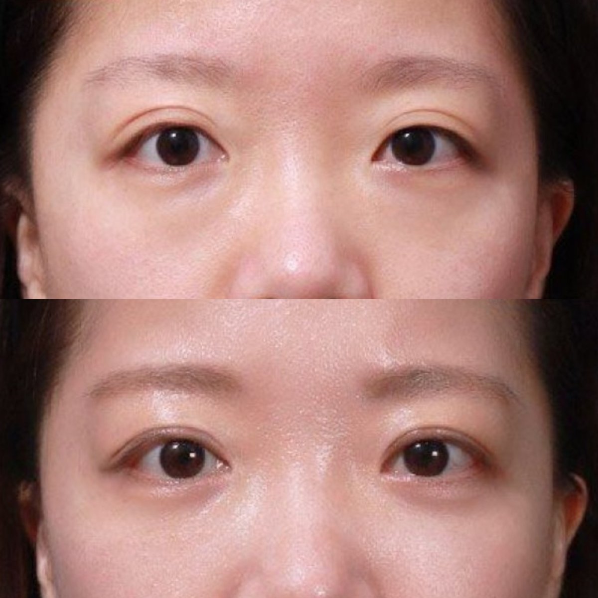 نتائج شد الجفن العلوي قبل وبعد في VG Plastic Surgery، تحسين شكل الجفن