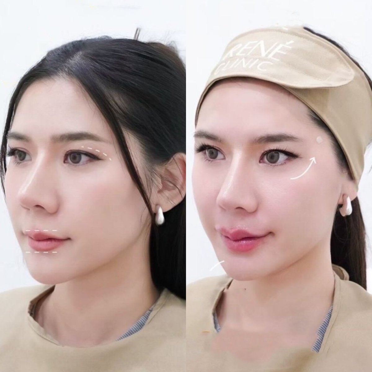 Resultados de lifting facial con hilos antes y después en la clínica, efecto de elevación visible