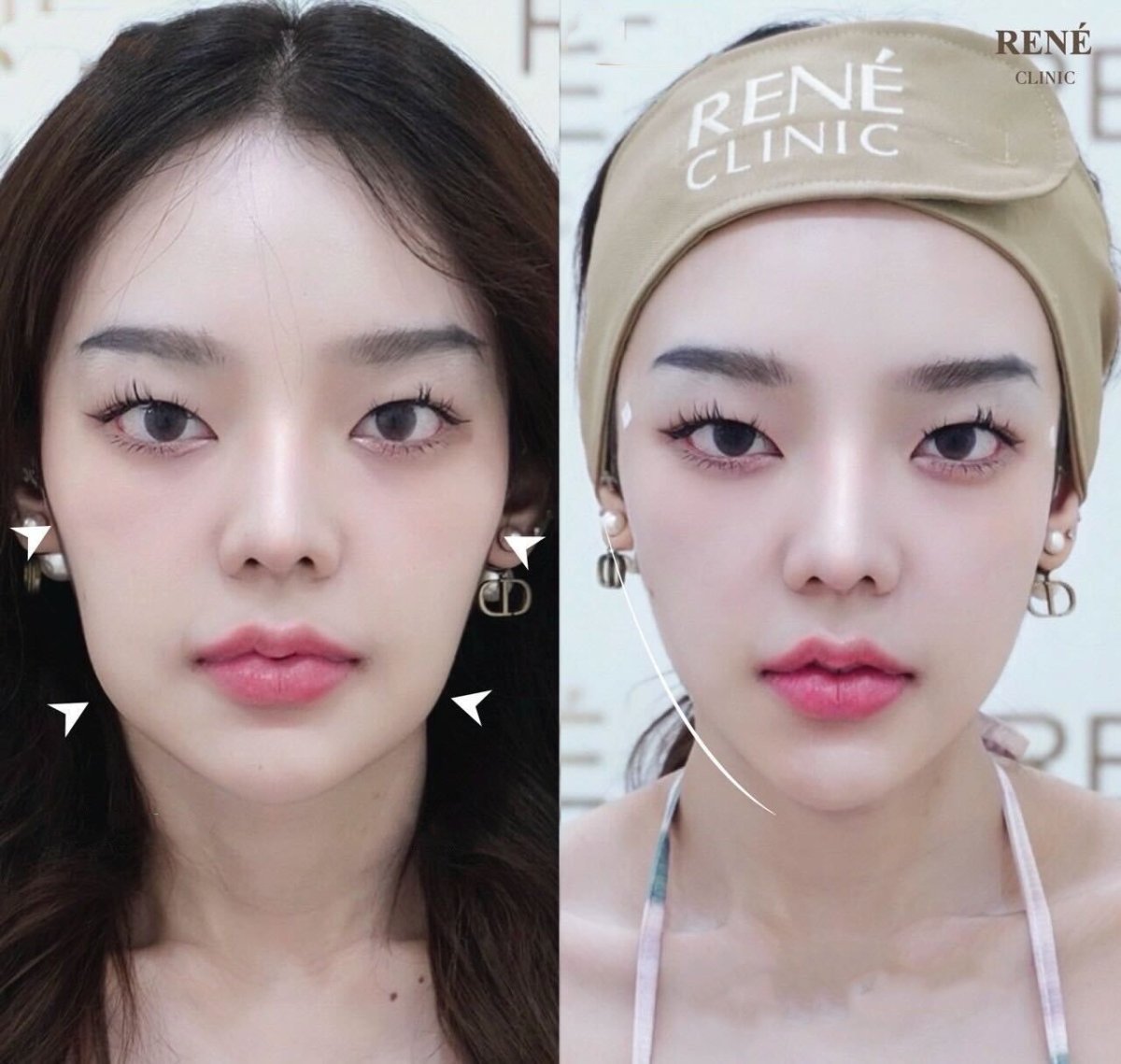 Resultados de lifting con hilos antes y después en René Clinic – mejora del contorno facial