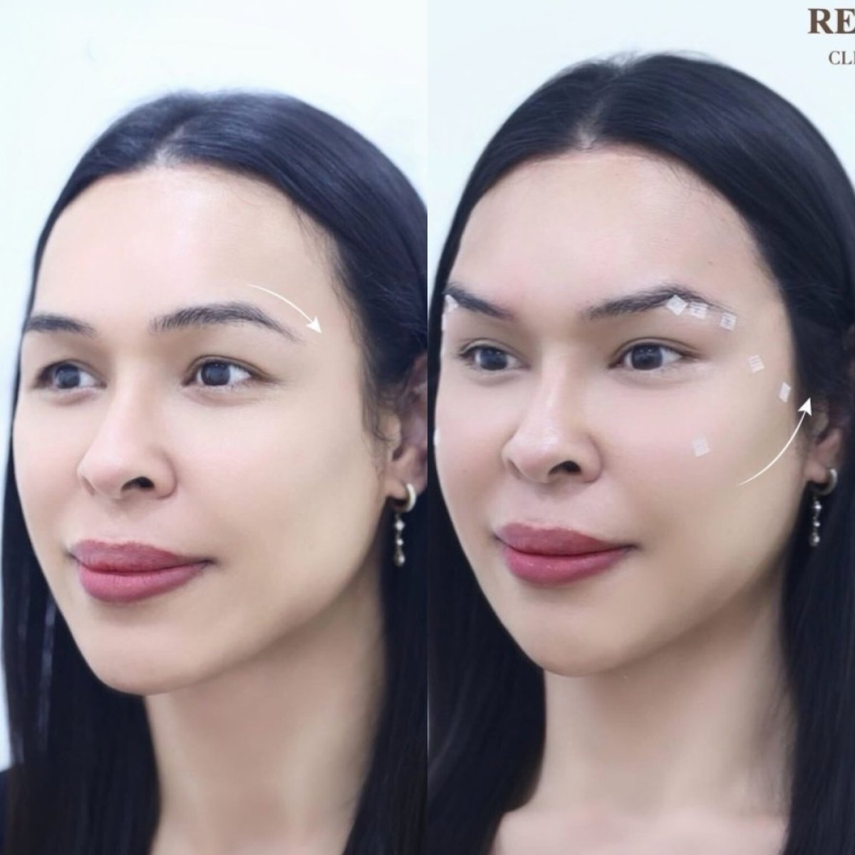 Résultats avant et après lifting par fils – rehaussement visible des sourcils et du visage