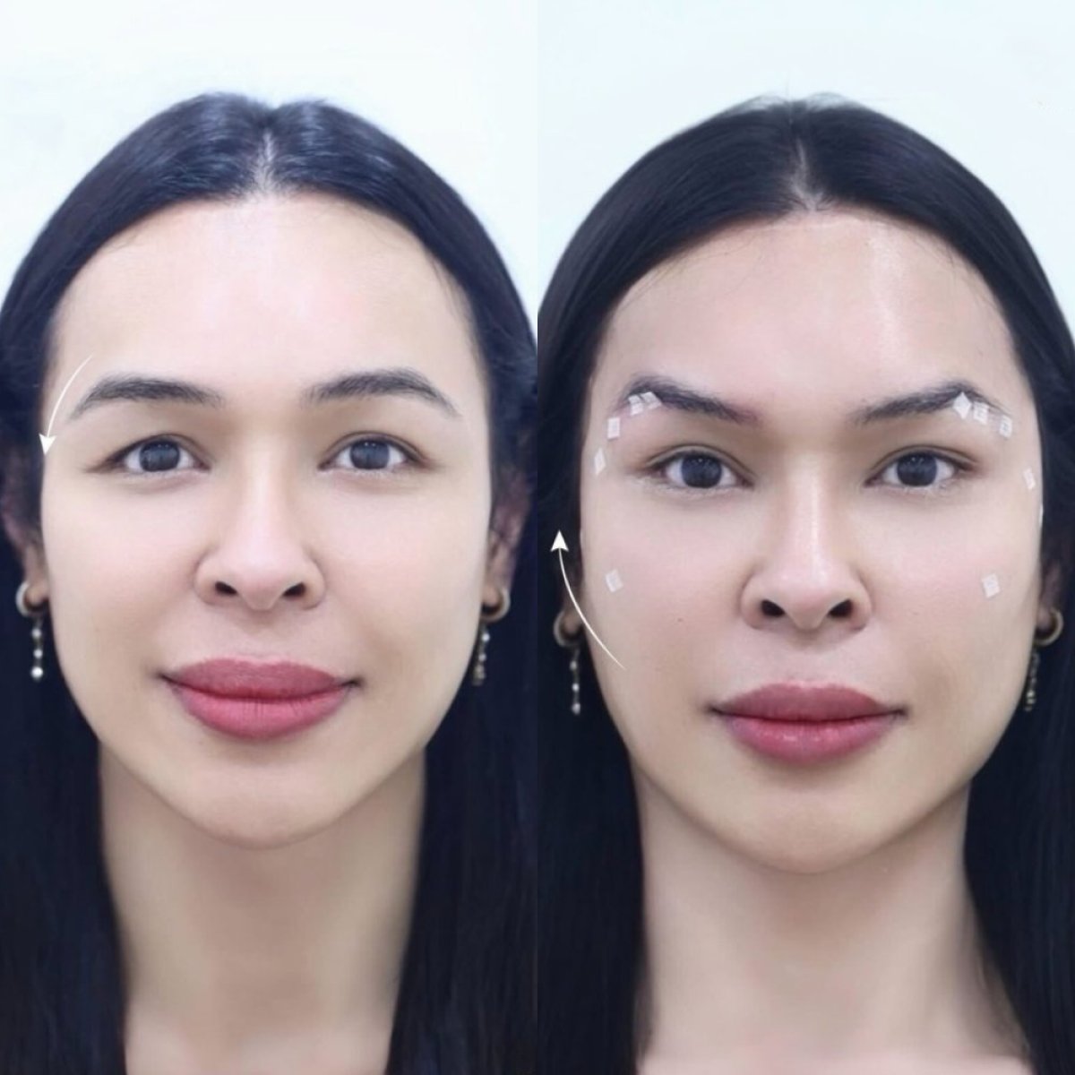 Before and after threads lifting results – visible eyebrow lift and smoother forehead