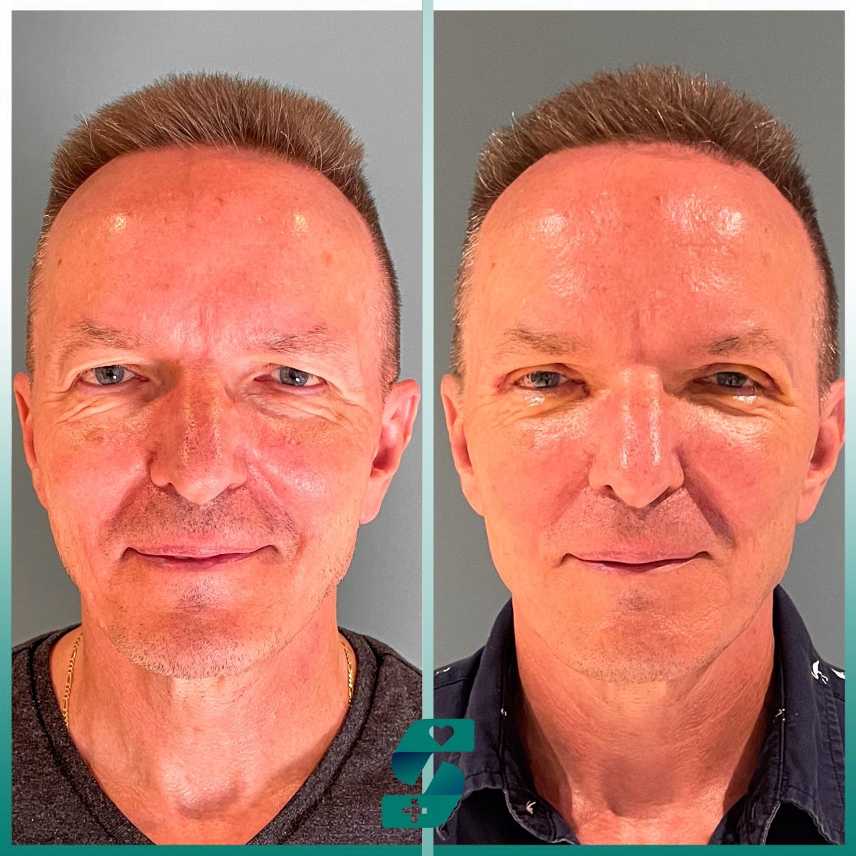 Resultados de blefaroplastia superior e inferior en Soraca Med, rejuvenecimiento ocular