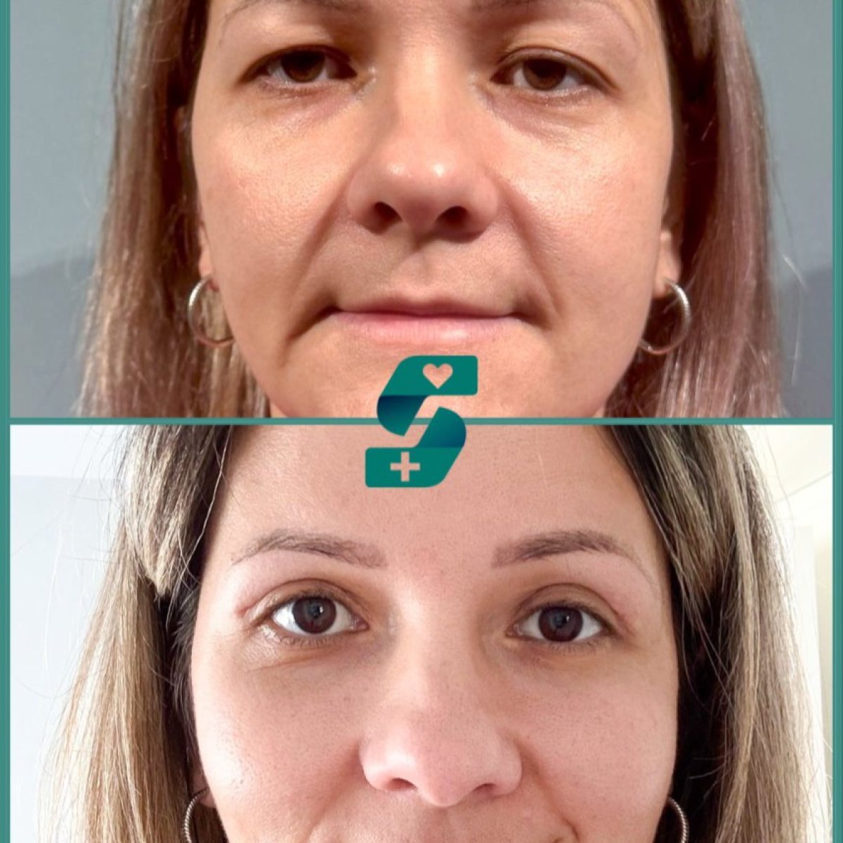 Resultados de blefaroplastia superior e inferior en Soraca Med, ojos rejuvenecidos