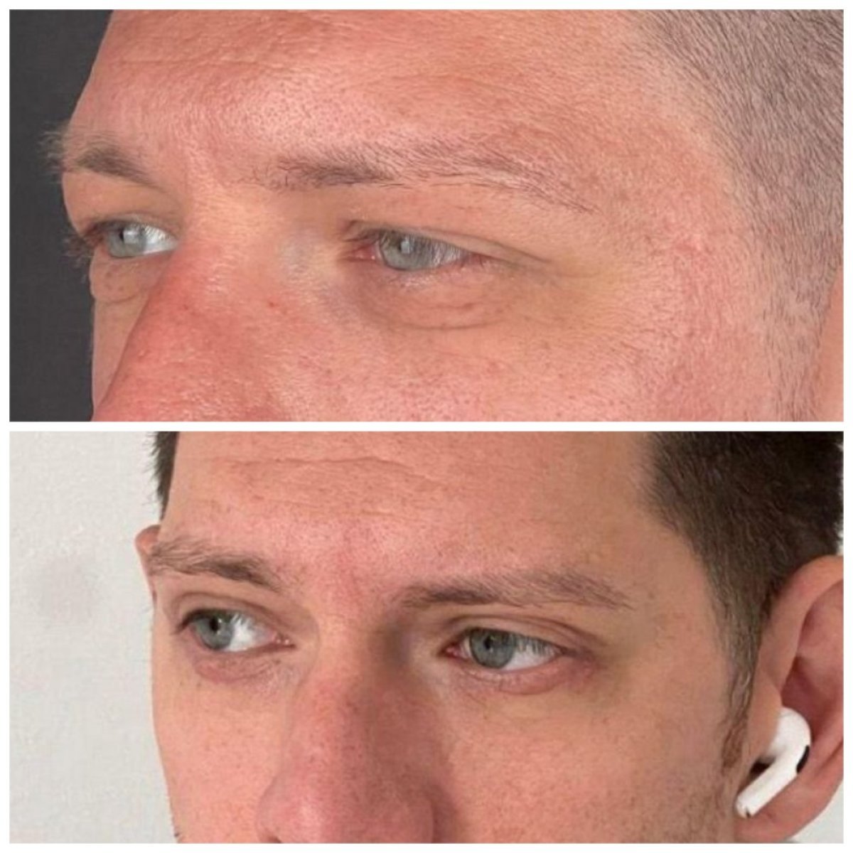 Before and after upper and lower eyelid surgery results at Soraca Med, rejuvenated eye area