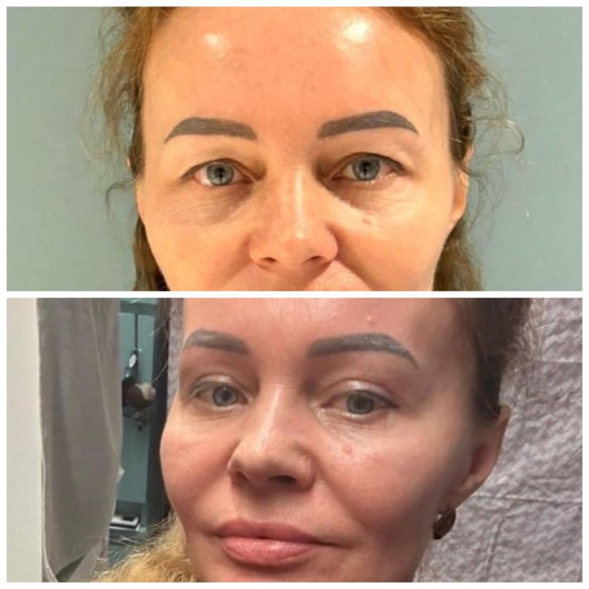 Before and after upper and lower eyelid surgery results at Soraca Med, rejuvenated eye area