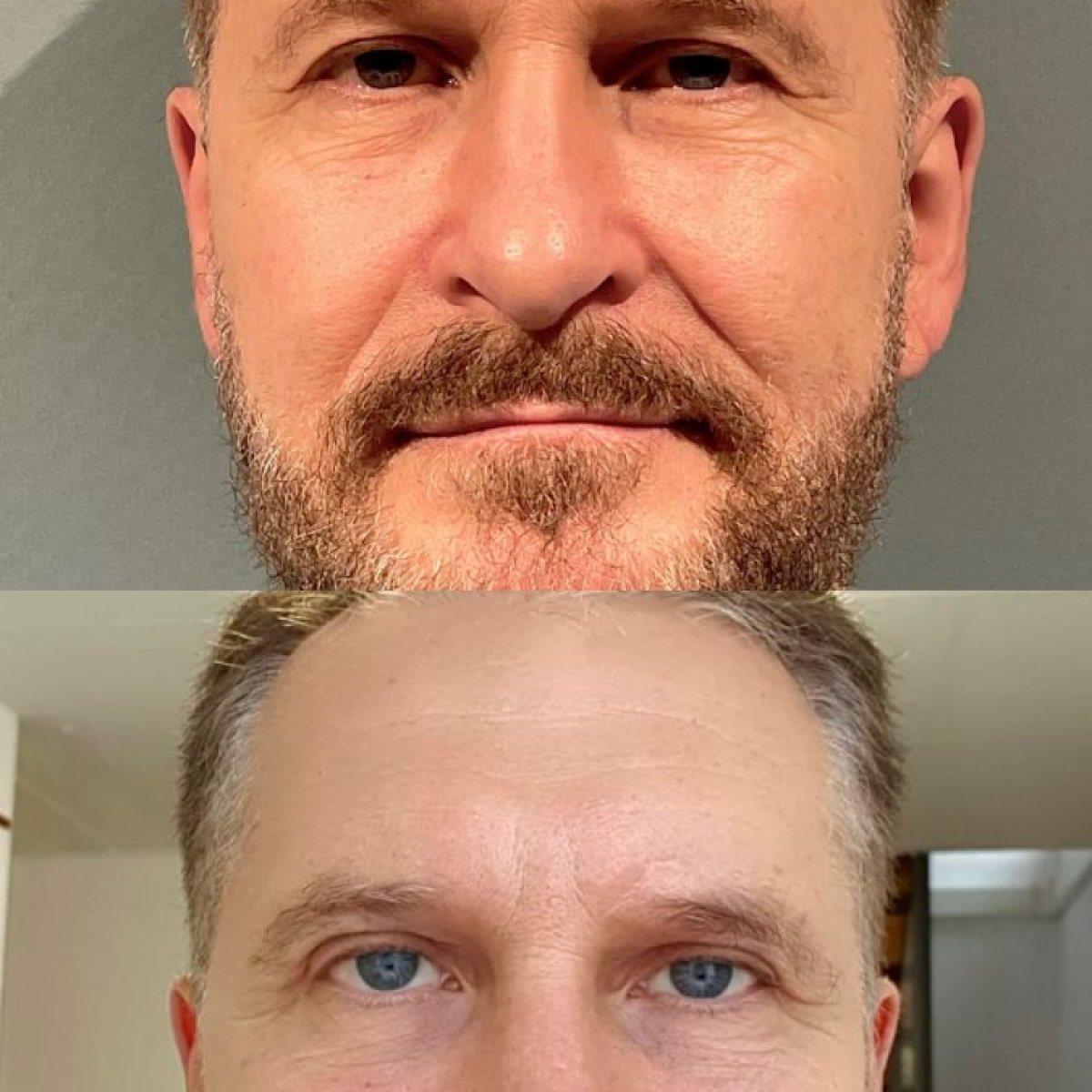 Before and after upper and lower eyelid surgery results at Soraca Med, rejuvenated appearance