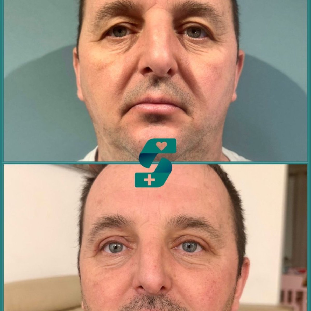 Before and after upper and lower eyelid surgery results at Soraca Med, rejuvenated eye area