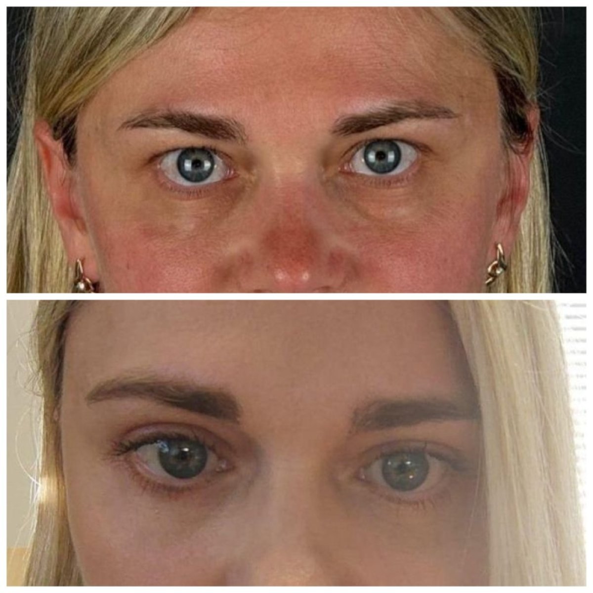 Before and after upper and lower eyelid surgery results at Soraca Med, rejuvenated eye area