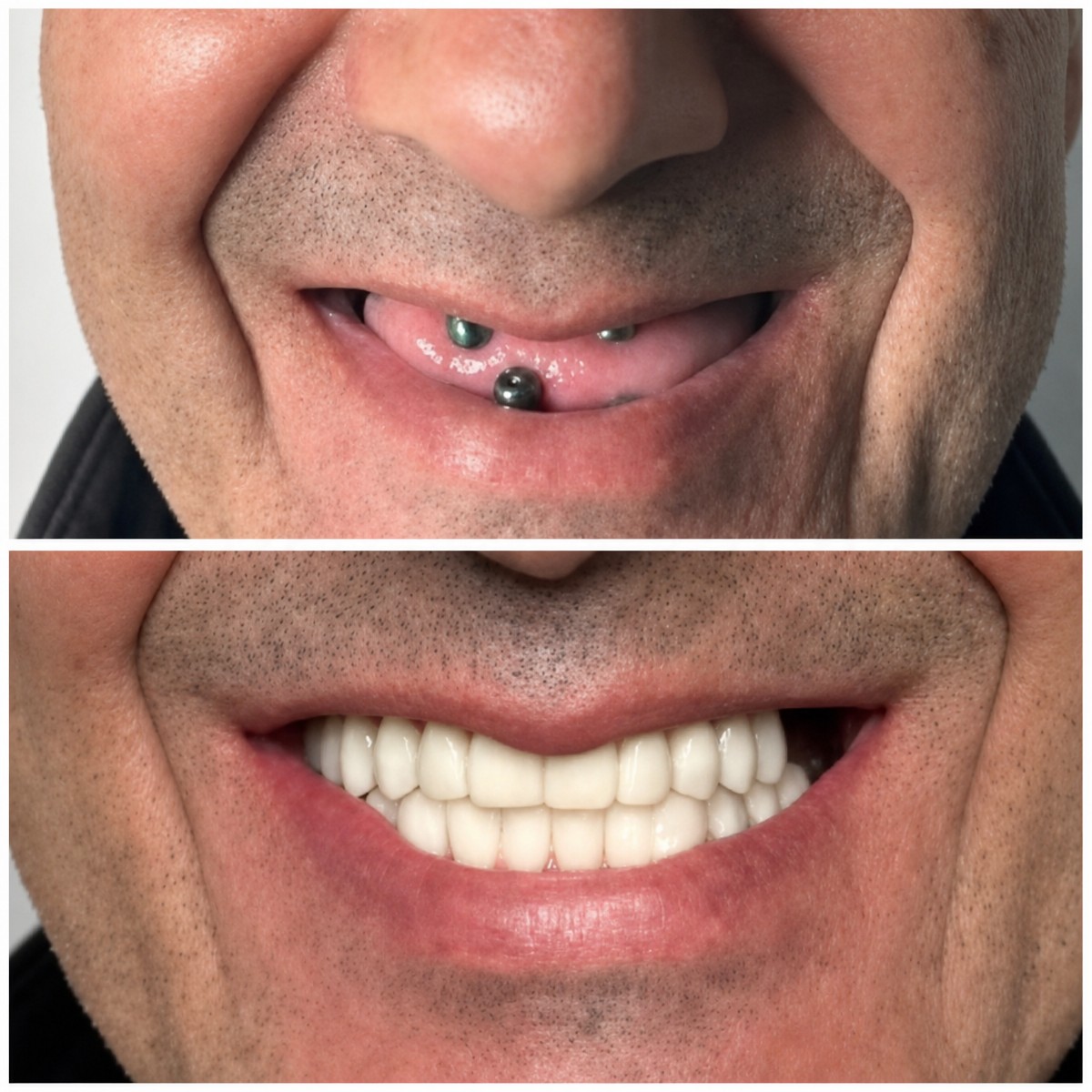 نتيجة قبل وبعد زراعة الأسنان All-on-4 في Santa Caterina Clinic، ابتسامة مستعادة