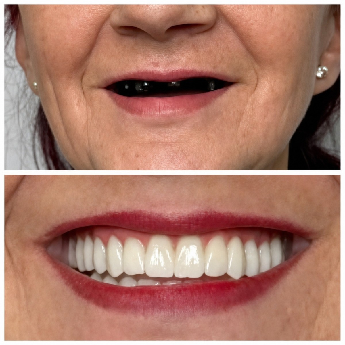 Before and after All-on-4 dental implants result at Santa Caterina Clinic, full smile restoration
