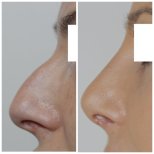 Fotos vor und nach Rhinoplastik (Nasenkorrektur) durch Dr. 