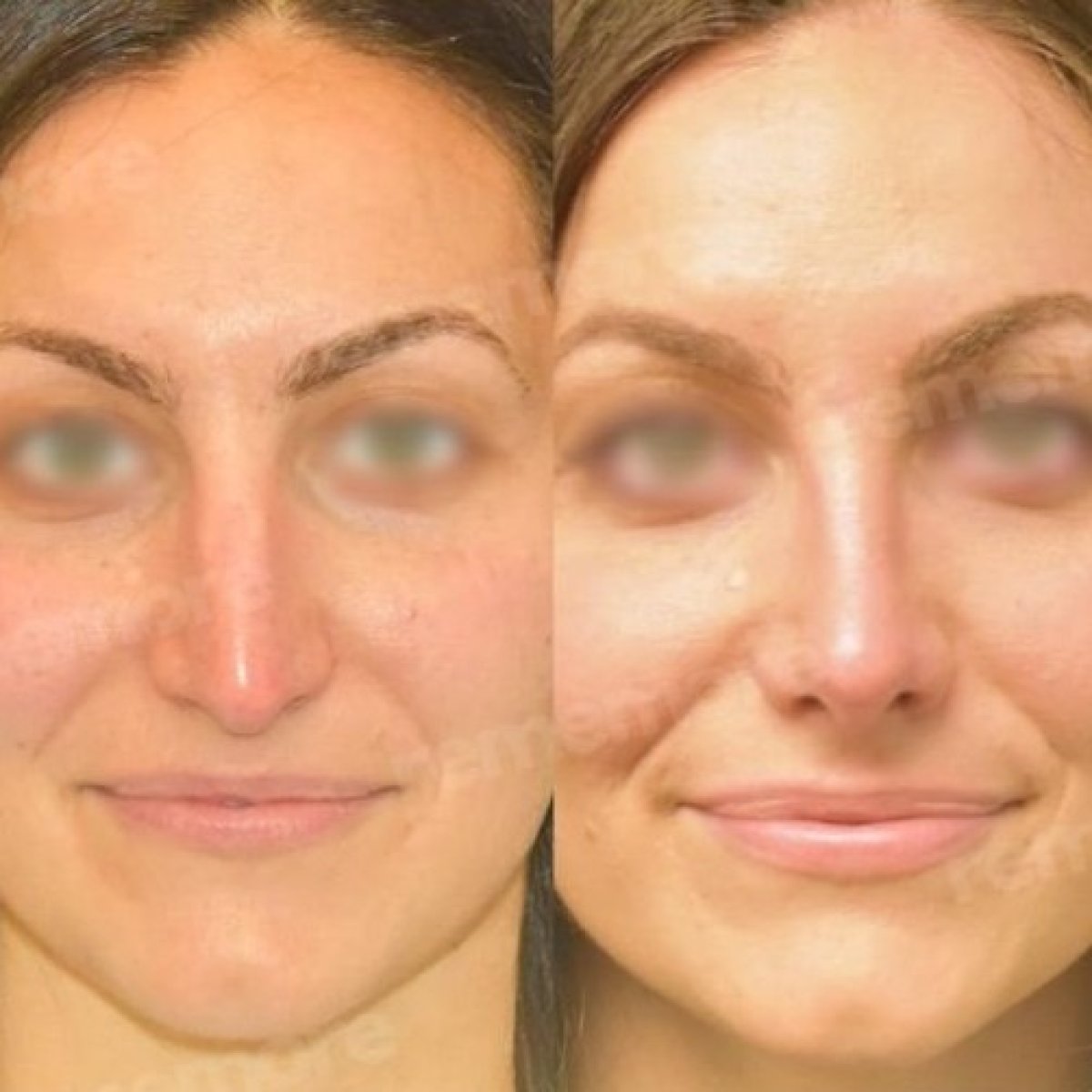 Before and after rhinoplasty results at Memorial Şişli Hospital, nose reshaping improvement