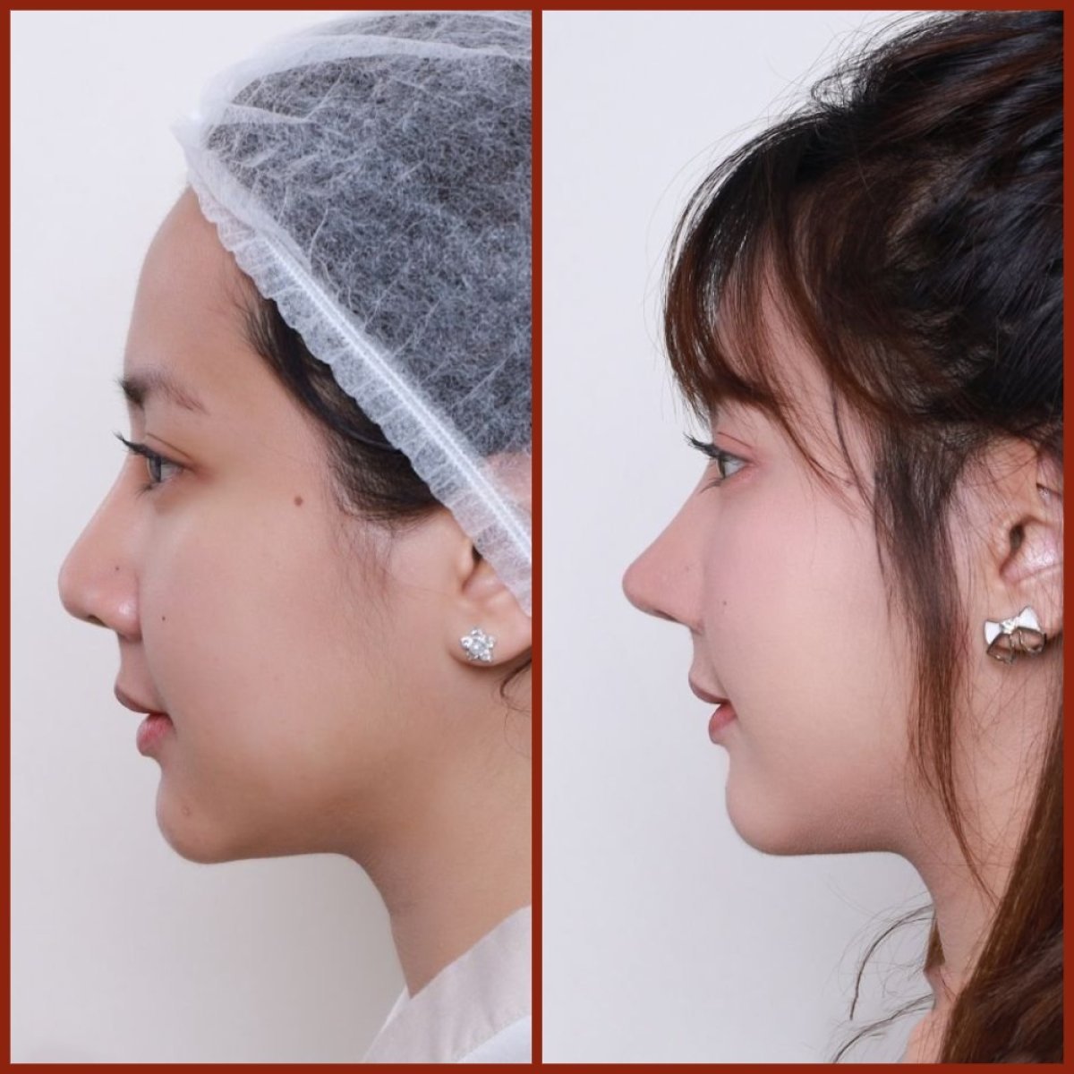 Before and after rhinoplasty at DGB Clinic, nose reshaping with natural result