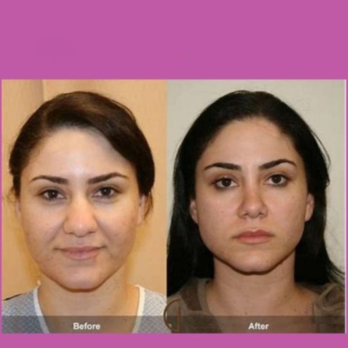 Before and after septoplasty results at ID Clinic Bangkok, improved nasal symmetry and breathing
