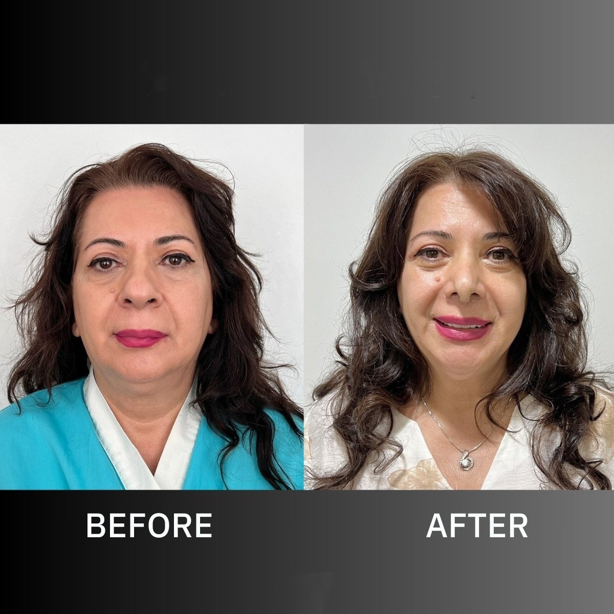 Before and after septoplasty results at ID Clinic Bangkok, improved nasal breathing and symmetry