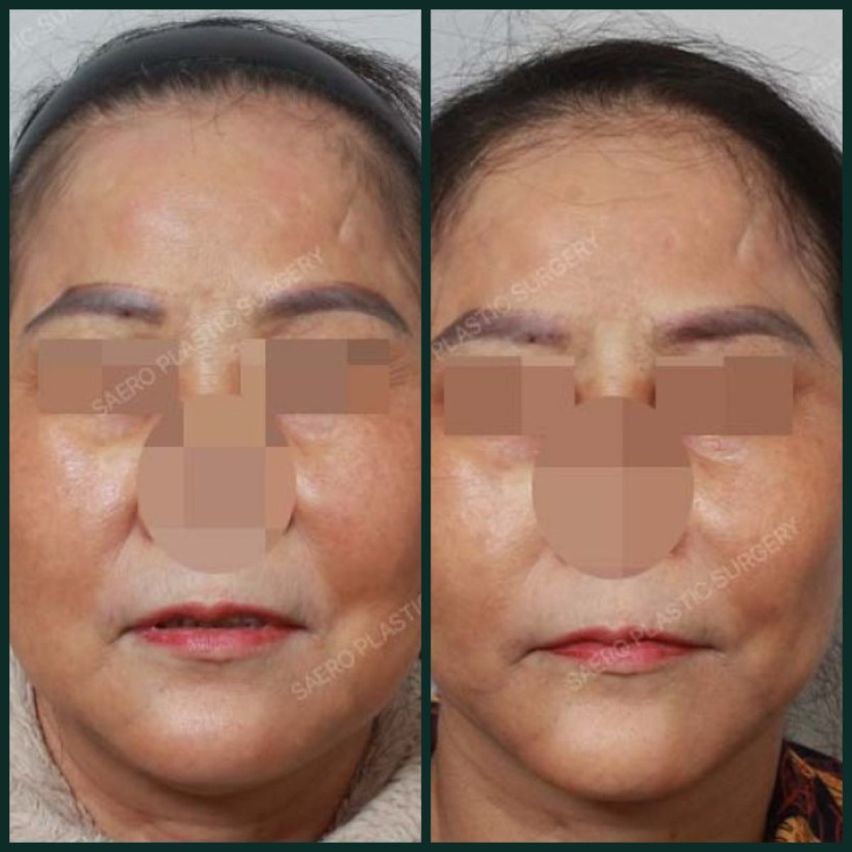 نتائج شد الجبهة قبل وبعد في SAERO Plastic Surgery، جبهة وحاجب أكثر نعومة