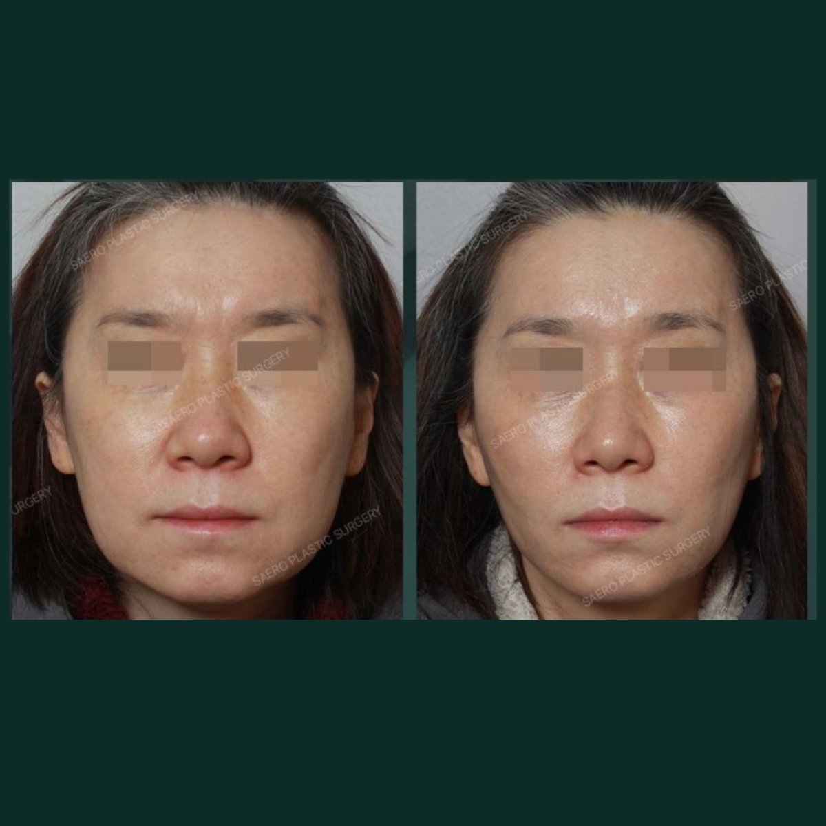 نتائج شد الجبهة قبل وبعد في SAERO Plastic Surgery، رفع واضح للحاجب