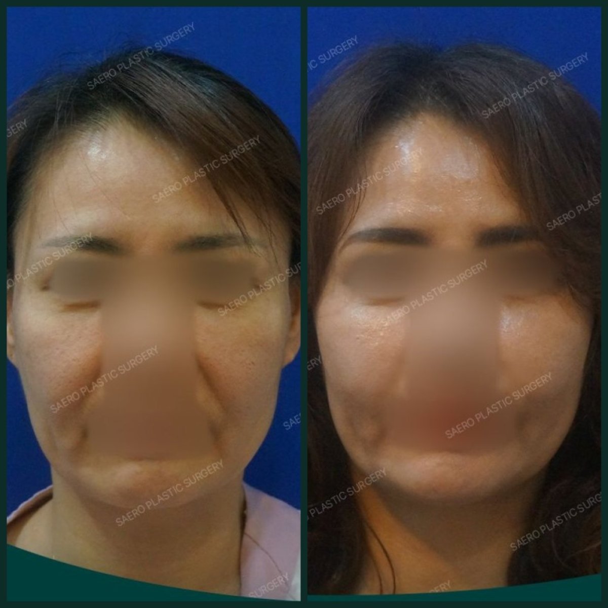 نتائج شد الجبهة قبل وبعد في SAERO Plastic Surgery، جبهة أكثر نعومة ورفعًا